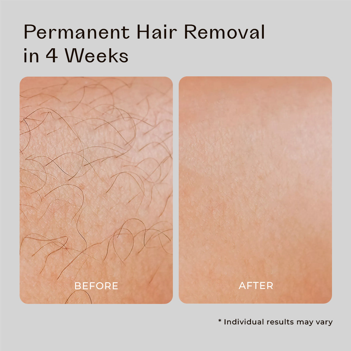 5MINSKIN AT-HOME LASER HÅRFJERNING HÅNDSETT - 50% RABATT INTERNASJONAL KVINNEDAGSSALG