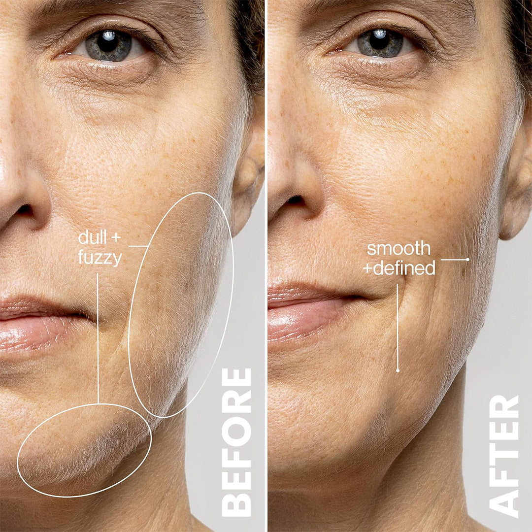 痤瘡和老年斑去除附件