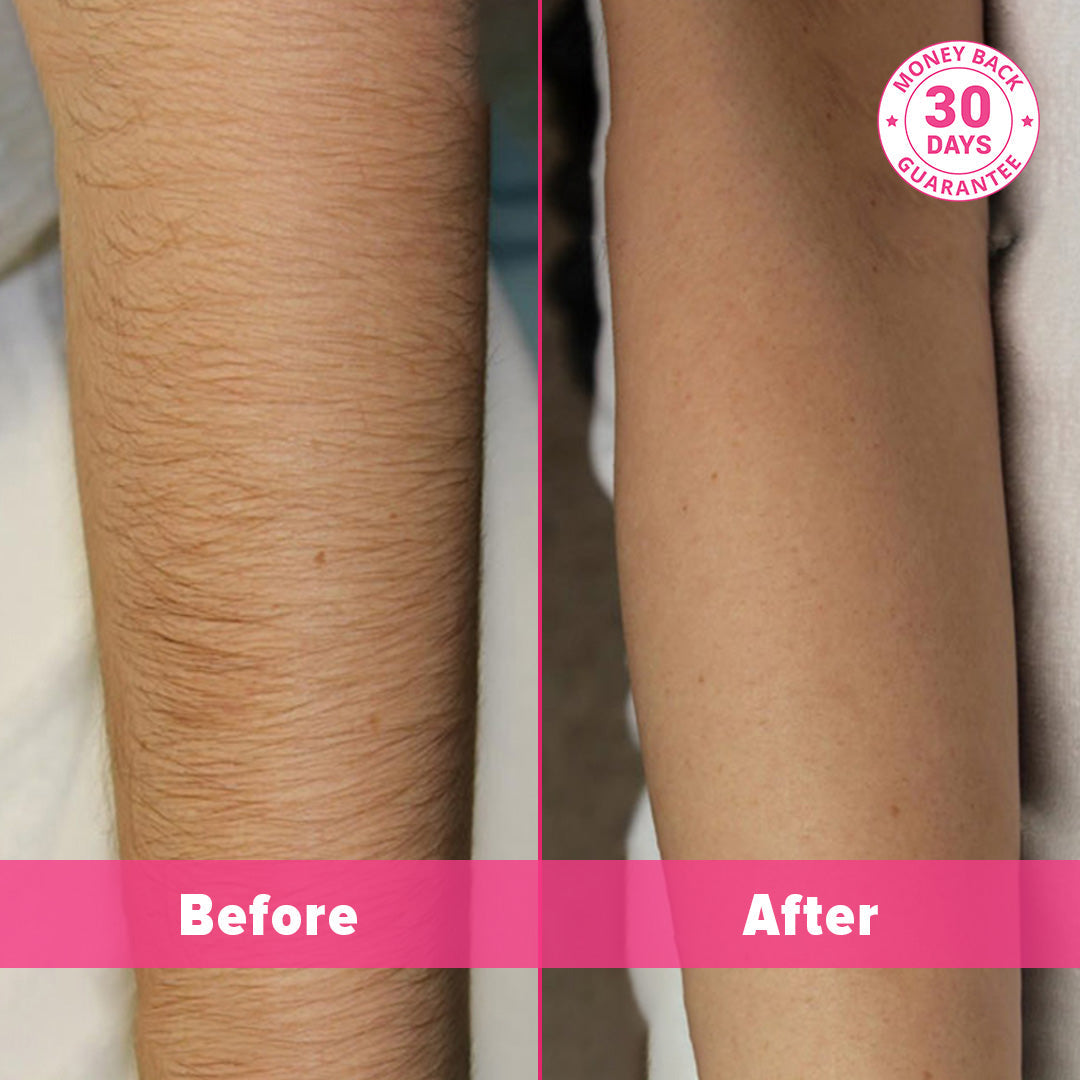 جهاز 5 مينسكين لإزالة الشعر بالليزر في المنزل